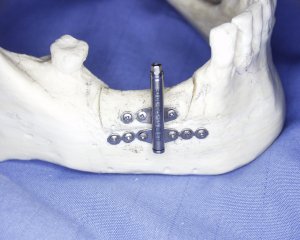 友生歯科医院の仮骨延長法