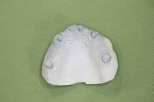 術前に製作した仮歯