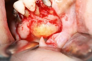 歯根膿胞
