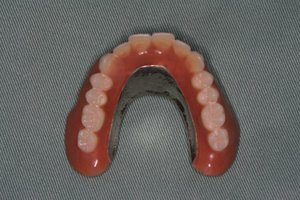 入れ歯の維持、支持にインプラントを使った症例　友生歯科医院