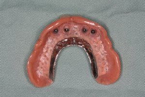 入れ歯の維持、支持にインプラントを使った症例　友生歯科医院