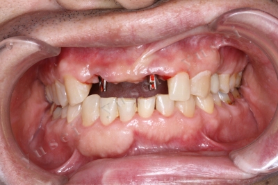 ３歯連続の前歯部欠損に対し ２本のインプラントで３歯をつくるブリッジワークを行った症例 山口院長ブログ 最近のインプラント治療