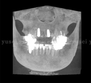 前歯部の３本連続欠損に対し、インプラントを使ったブリッジで治療を行う症例1