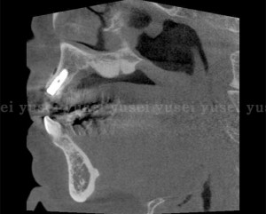 前歯部の３本連続欠損に対し、インプラントを使ったブリッジで治療を行う症例2