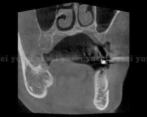 左上臼歯部にラテラルウインドウテクニックでサイナスリフトを行った症例1