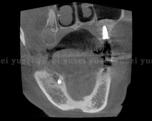 左上臼歯部にラテラルウインドウテクニックでサイナスリフトを行った症例2