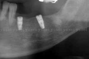 アトランティスアバットメントを用いた臼歯部のインプラント修復1