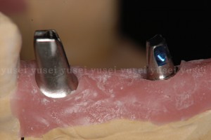 アトランティスアバットメントを用いた臼歯部のインプラント修復3