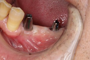 アトランティスアバットメントを用いた臼歯部のインプラント修復4