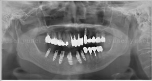 アトランティスアバットメントを用いて下顎の多数歯欠損補綴を行った症例1