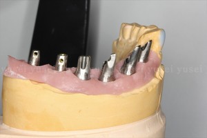 アトランティスアバットメントを用いて下顎の多数歯欠損補綴を行った症例2