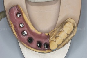 アトランティスアバットメントを用いて下顎の多数歯欠損補綴を行った症例3
