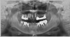 骨の委縮がみられる上顎前歯部欠損に対し、インプラントによる審美修復を行った症例01