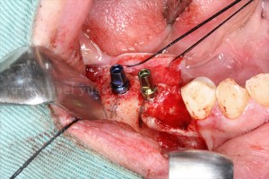 右下顎に２本のインプラントを埋入し骨補填剤を充填した症例02