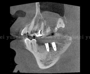 右下顎に２本のインプラントを埋入し骨補填剤を充填した症例03