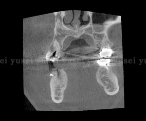 右下顎に２本のインプラントを埋入し骨補填剤を充填した症例05