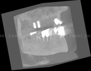 上顎に４本のインプラントを埋入し、総義歯に維持、支持装置を付けるＩＯＤを行う症例01