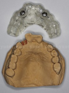 サージカルガイドを用いて審美領域にインプラント抜歯時即時埋入を行った症例01