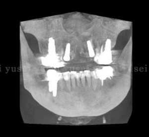 サージカルガイドを用いて審美領域にインプラント抜歯時即時埋入を行った症例04