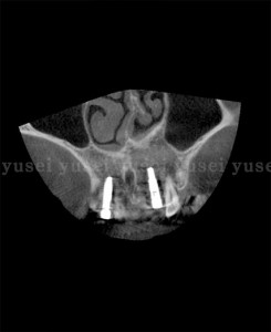 サージカルガイドを用いて審美領域にインプラント抜歯時即時埋入を行った症例05