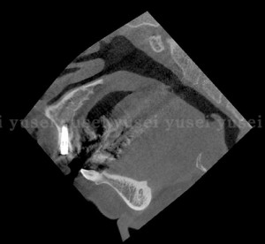 サージカルガイドを用いて審美領域にインプラント抜歯時即時埋入を行った症例06