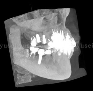 洞粘膜の薄い患者さんに対し上顎洞底拳上手術を行った症例02