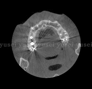 洞粘膜の薄い患者さんに対し上顎洞底拳上手術を行った症例04