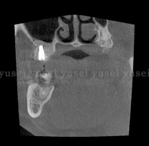 上顎臼歯部にサイナスリフトを行いＸｉｖｅインプラントを埋入した症例_03