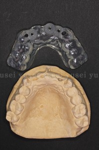 審美領域に歯牙支持型のサージカルガイドを使ってインプラントを埋入した症例01