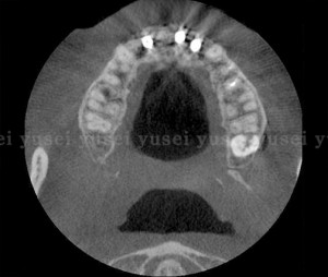 審美領域に歯牙支持型のサージカルガイドを使ってインプラントを埋入した症例07