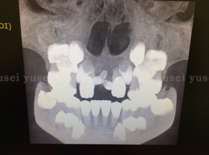 子どもの過剰埋伏歯を抜歯した症例_01