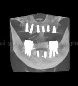 頬舌幅が足りない下顎骨にサージカルガイドを用いてインプラントを埋入した症例_04