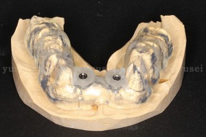 頬舌幅が足りない下顎骨にサージカルガイドを用いてインプラントを埋入した症例_01
