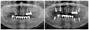 両側の臼歯部にインプラントを埋入し、全顎的な治療を行うことになった症例_01