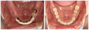 両側の臼歯部にインプラントを埋入し、全顎的な治療を行うことになった症例_03