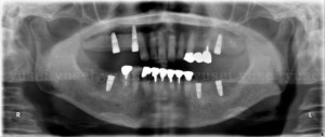 両側の臼歯部にインプラントを埋入し、全顎的な治療を行うことになった症例_１右