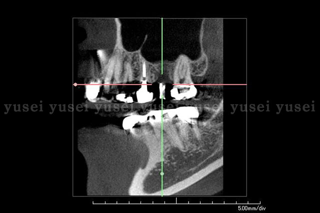 上顎洞底挙上手術について   山口院長ブログ 最近のインプラント治療