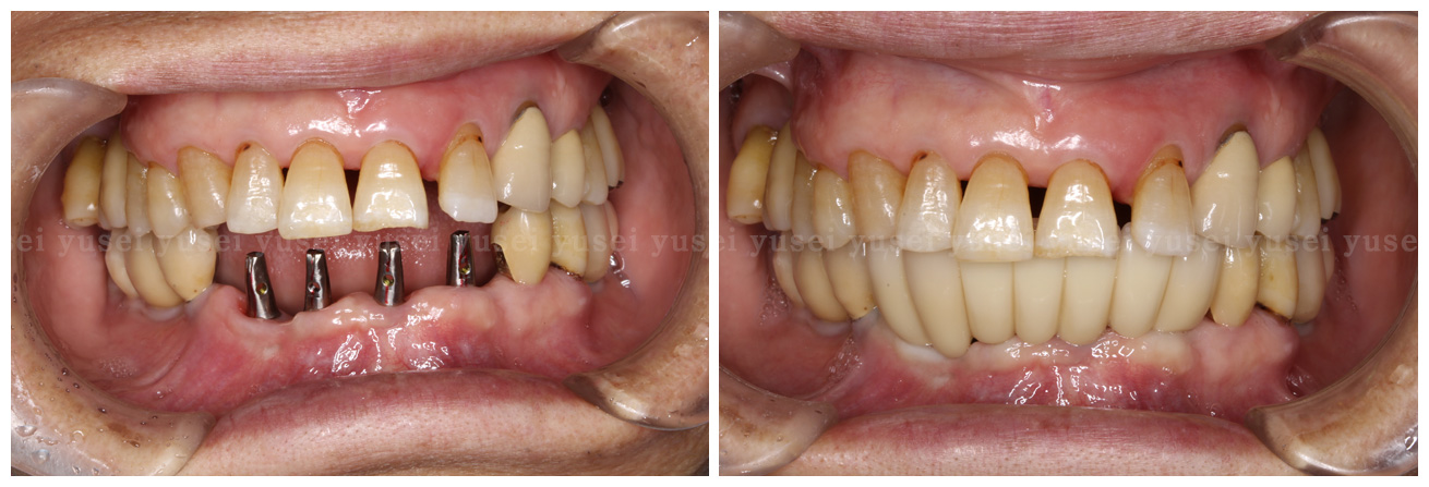 下顎前歯部に仮歯を入れないで最終補綴物を装着した症例 山口院長ブログ 最近のインプラント治療