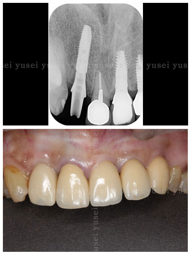 審美性を追求した上顎前歯部のインプラント治療 - 山口院長ブログ